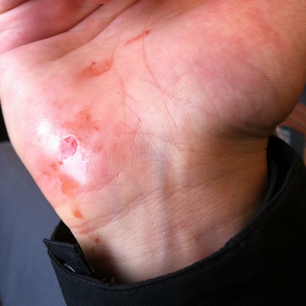 Scooter fall result