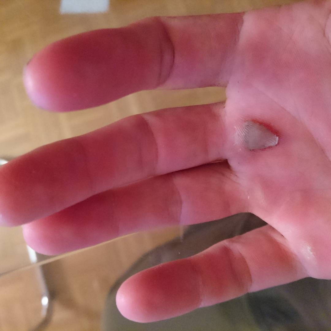 A bouldering injury. Nothing serious. Nice flapper.