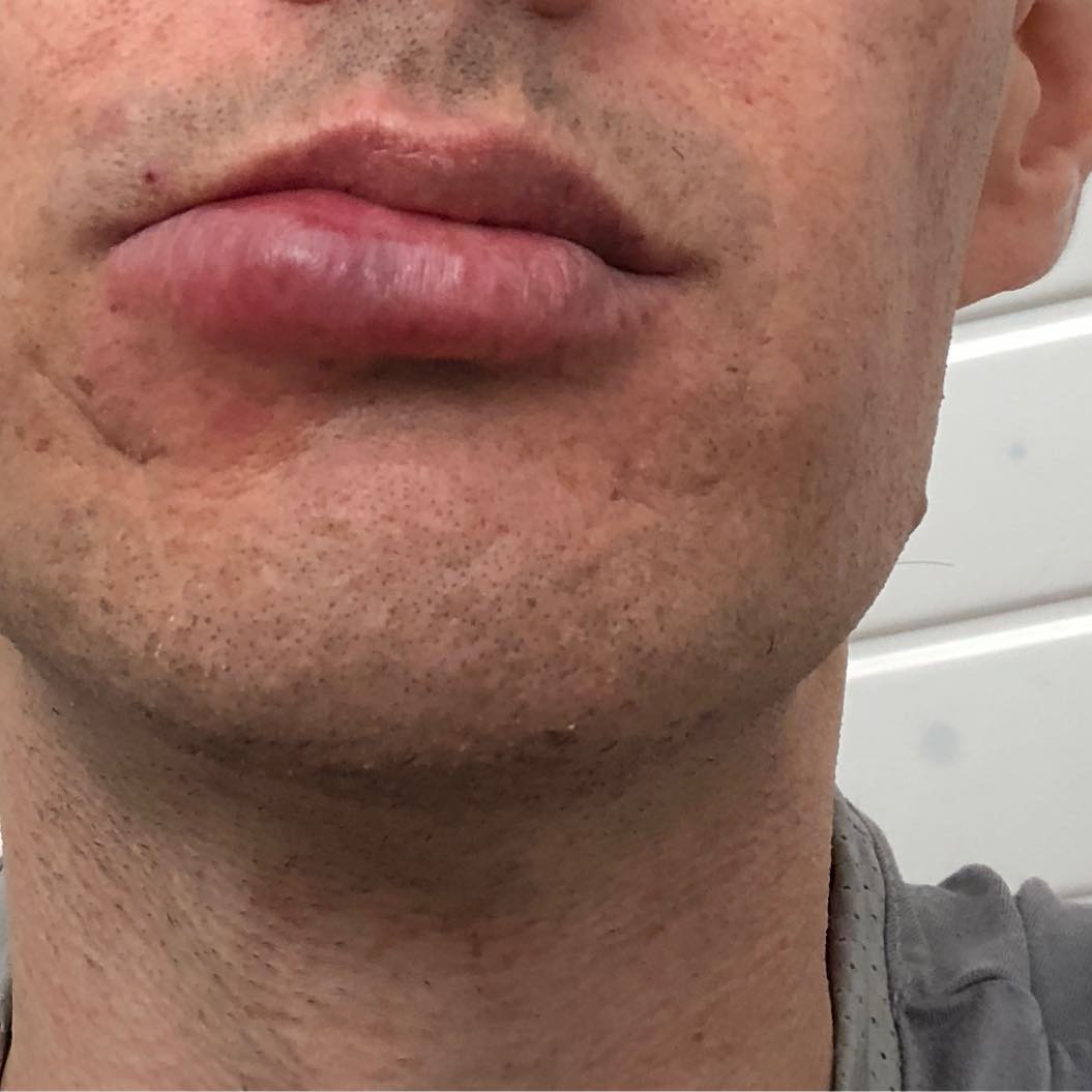 Taking a bike rather than a scooter or car to be environmentally friendly can be painful. I was stung for the second time this year and this time it has left a nice swelling. I was coming back from the shops.
